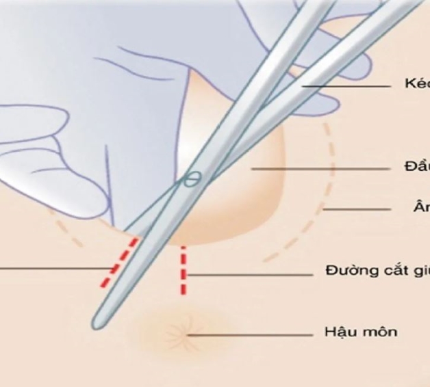 Hỏi đáp: Đẻ thường rạch tầng sinh môn bao lâu thì lành?