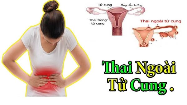 Hỏi đáp: Làm gì khi chửa ngoài tử cung?