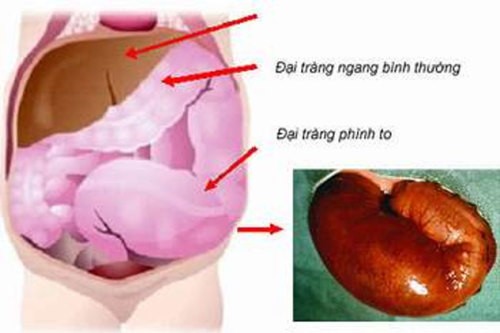 Hỏi đáp về bệnh phình đại tràng bẩm sinh