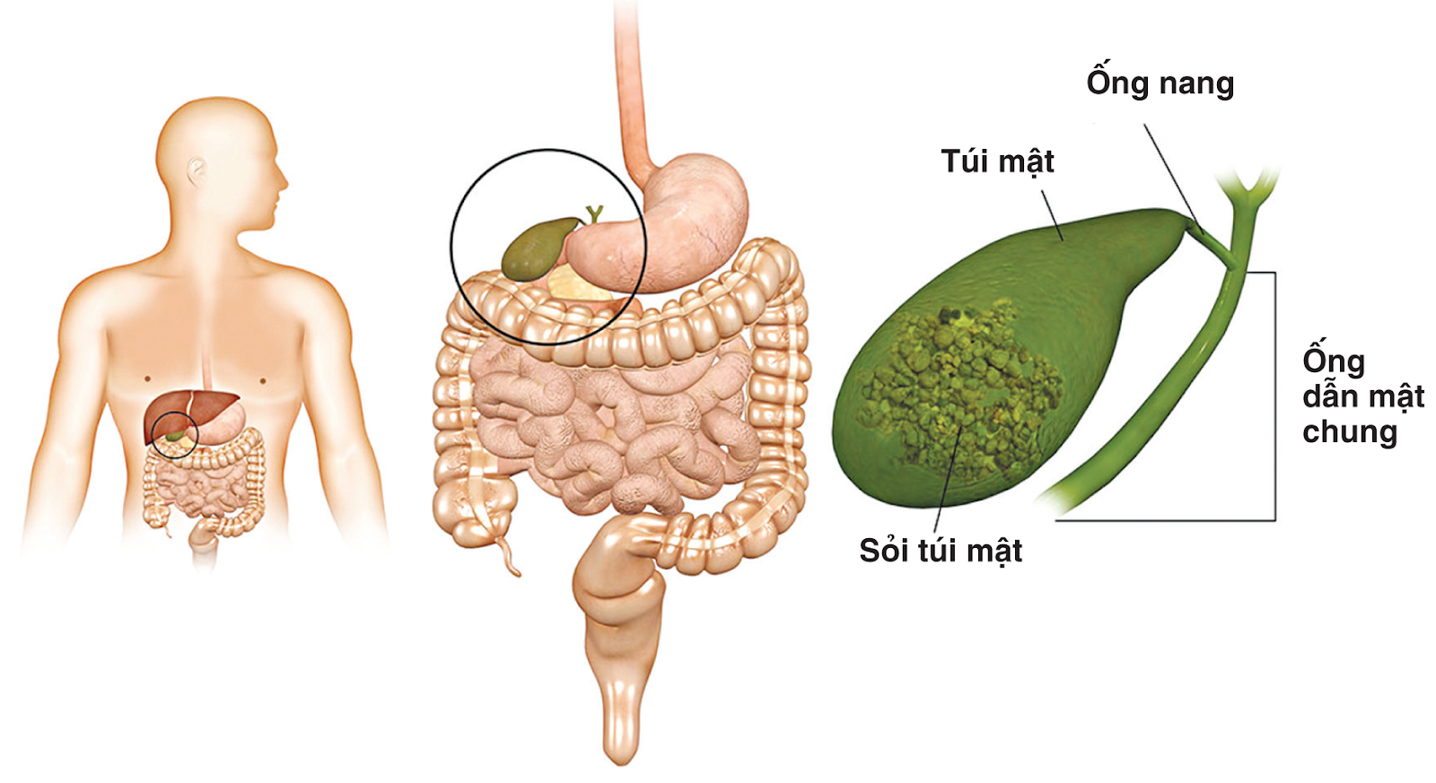 Hỏi đáp về bệnh sỏi mật căn bệnh nguy hiểm