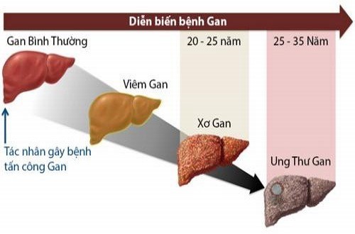 Hôn có lây nhiễm viêm gan B không?