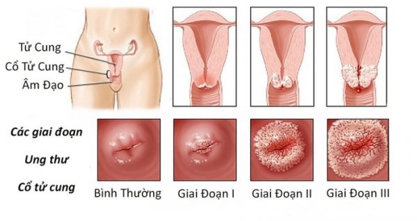 HPV ung thư cổ tử cung: Các giai đoạn bệnh và cách điều trị tương ứng