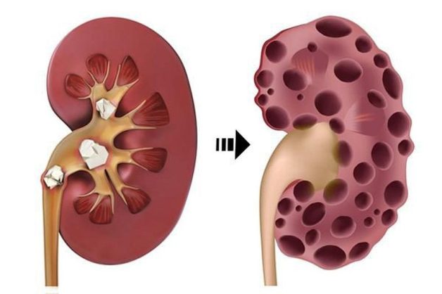 Hướng dẫn cách điều trị sỏi đường tiết niệu