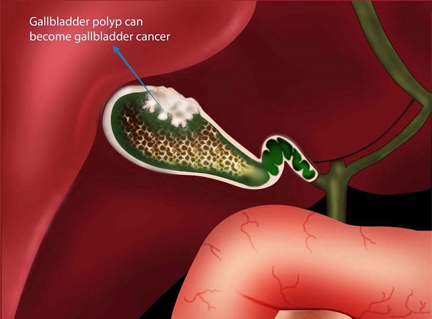 Hướng dẫn cách xử lý khi bị polyp túi mật