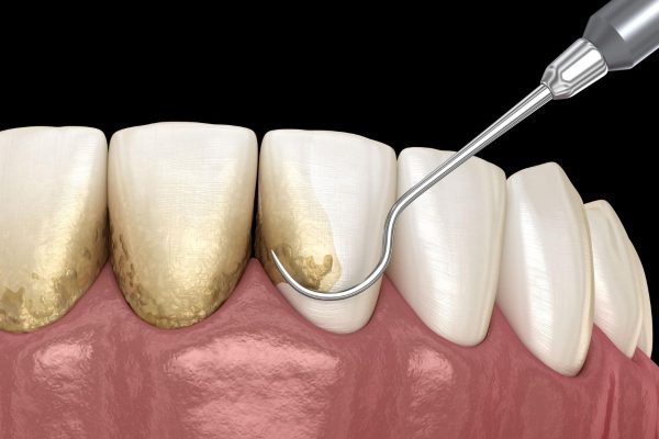 Hướng dẫn chăm sóc răng sau khi lấy cao răng