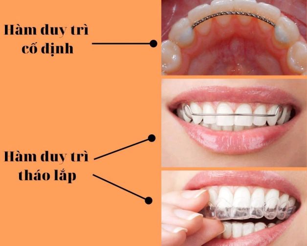 Hướng dẫn chăm sóc răng sau niềng đúng cách