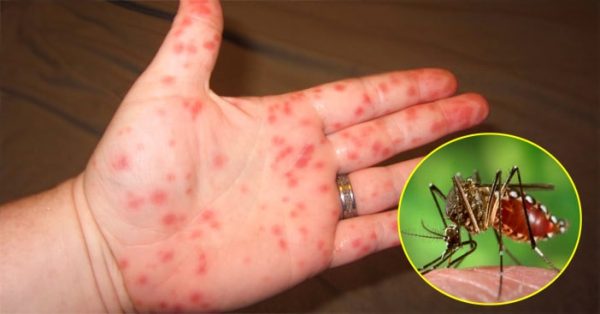 Hướng dẫn chăm sóc trẻ bị sốt xuất huyết Dengue