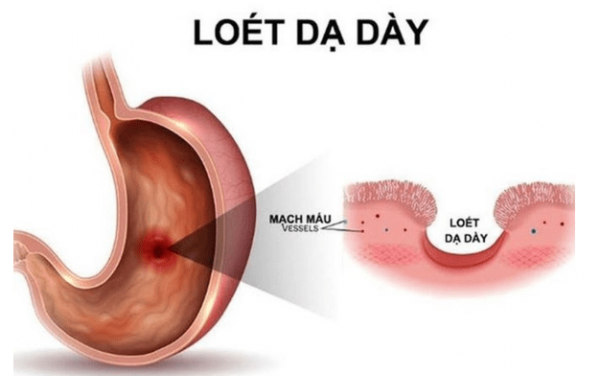 Hướng dẫn điều trị loét dạ dày tá tràng hiệu quả