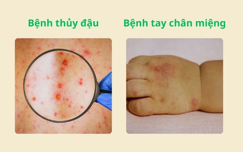 Hướng dẫn phân biệt dấu hiệu bệnh thủy đậu và tay chân miệng