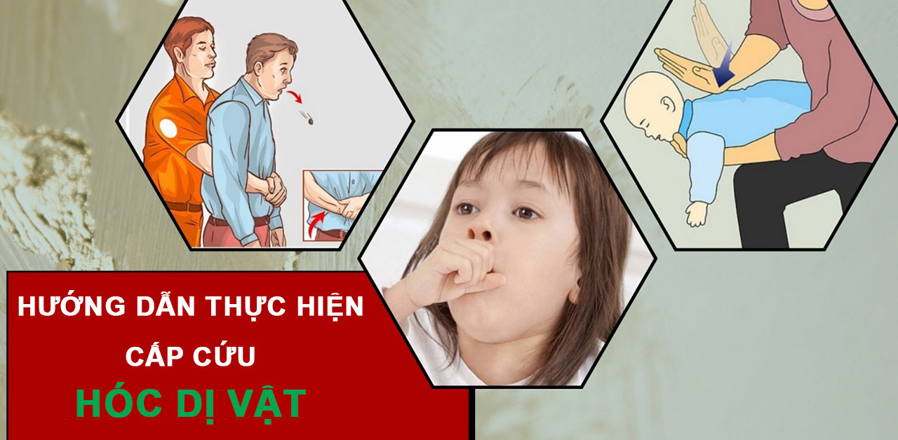 Hướng dẫn thực hiện cấp cứu hóc dị vật