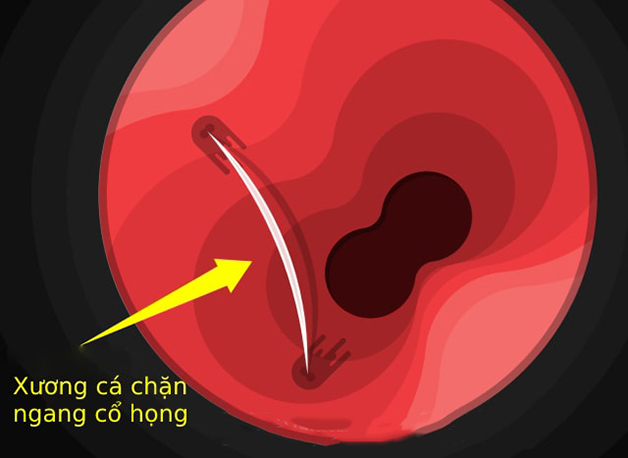 Hướng dẫn xử trí trẻ em hóc xương cá đảm bảo an toàn