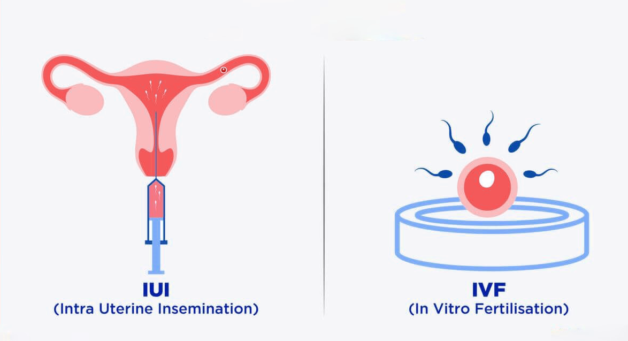 IUI và IVF là gì? Tìm hiểu sự khác nhau của hai phương pháp này