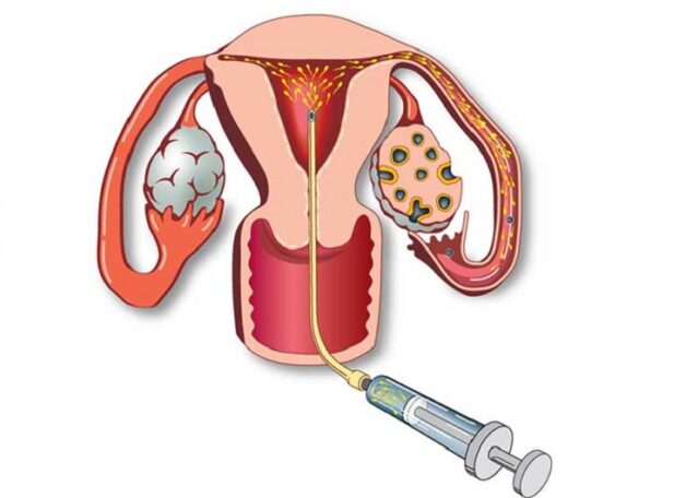 IUI và IVF là gì? Tìm hiểu sự khác nhau của hai phương pháp này