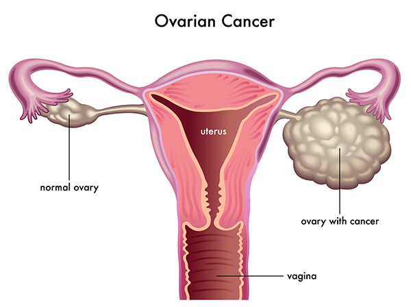 IVF có làm tăng nguy cơ bị ung thư buồng trứng không?