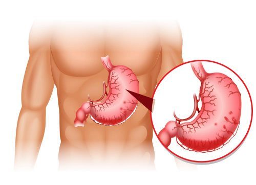 Kế hoạch chăm sóc xuất huyết tiêu hóa