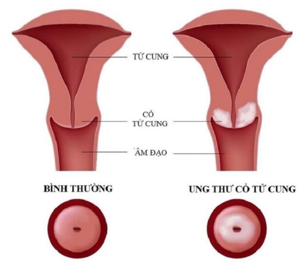 Kết quả soi cổ tử cung bất thường là như thế nào?