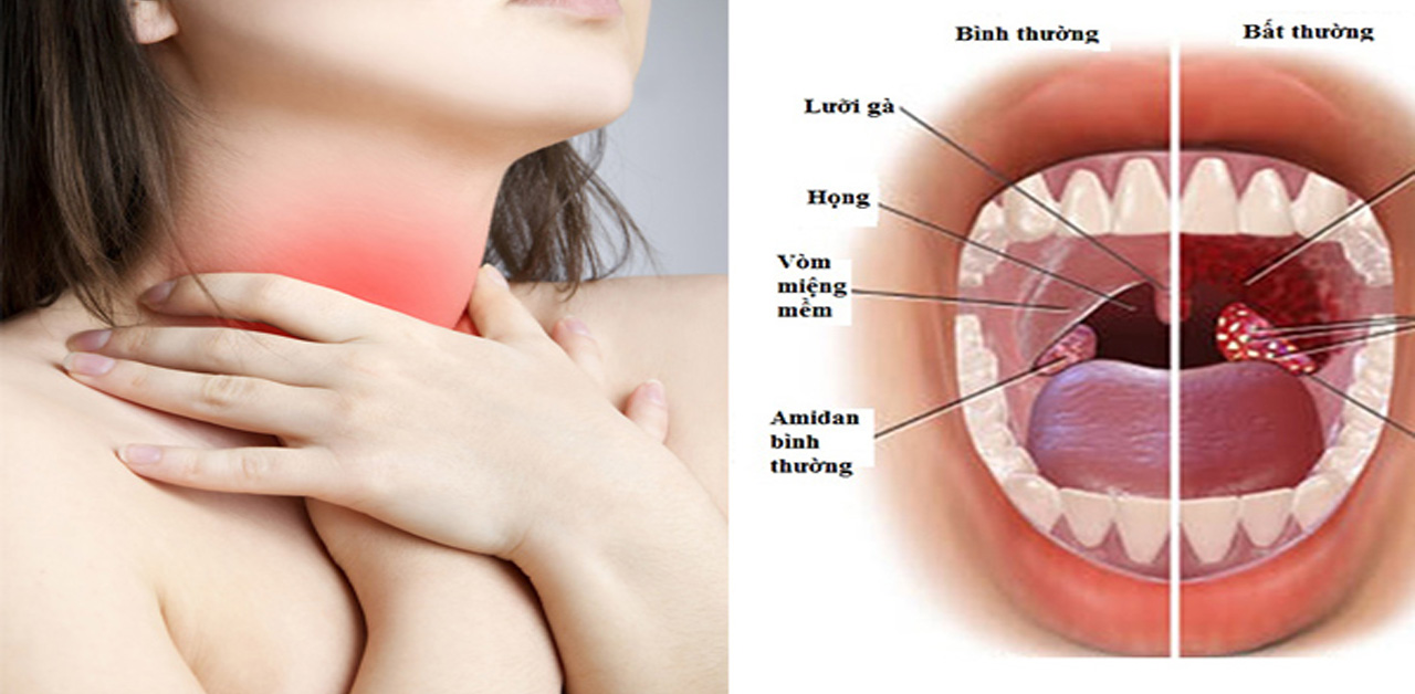 Khạc đờm ra máu có nguy hiểm không?