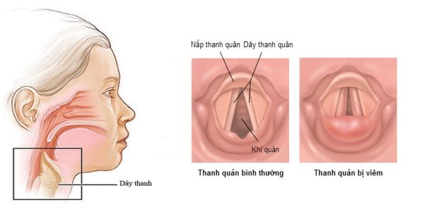 Khạc đờm ra máu có nguy hiểm không?