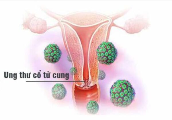 Khái quát chung về hpv ung thư cổ tử cung