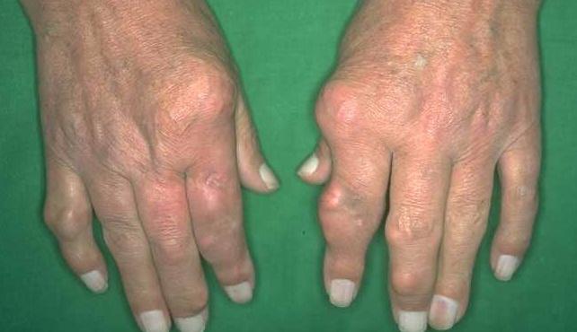 Khám bệnh Gout ở đâu tốt?là căn bệnh của người giàu