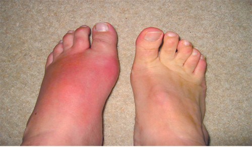 Khám bệnh Gout ở đâu tốt?là căn bệnh của người giàu