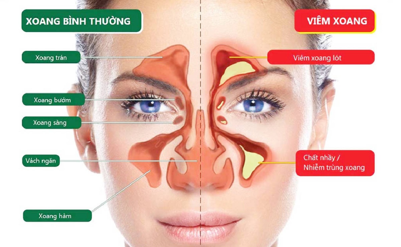 Khám bệnh viêm xoang uy tín ở đâu, chữa viêm xoang