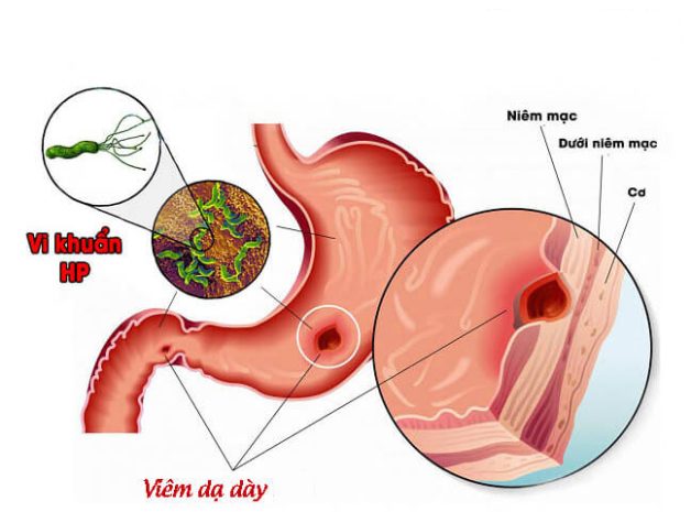 Khám đau dạ dày là khám những gì? Khám ở đâu tốt?