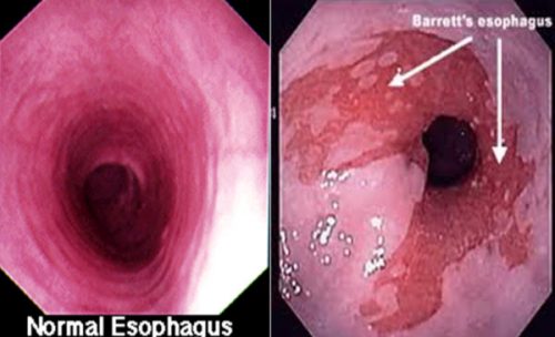 Khám nội soi thực quản phát hiện trào ngược dạ dày
