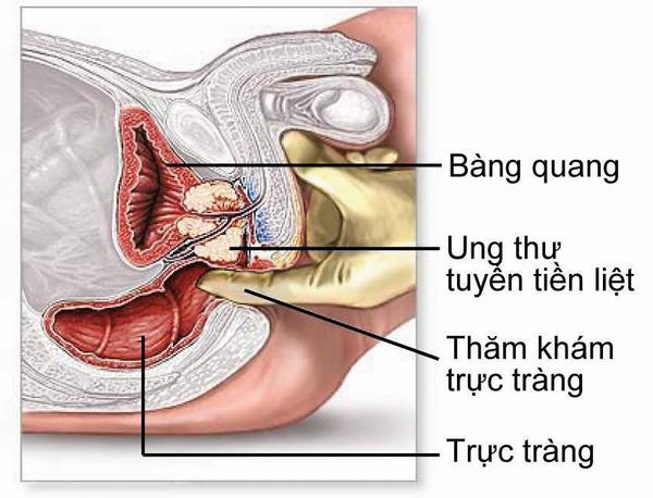 Khám phát hiện sớm ung thư tuyến tiền liệt