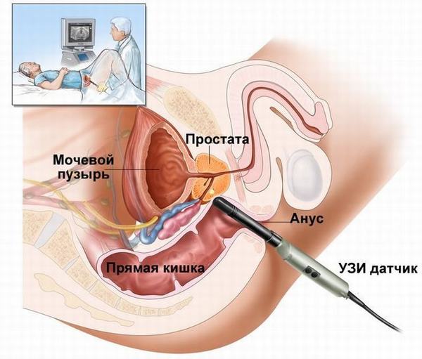 Khám phát hiện sớm ung thư tuyến tiền liệt