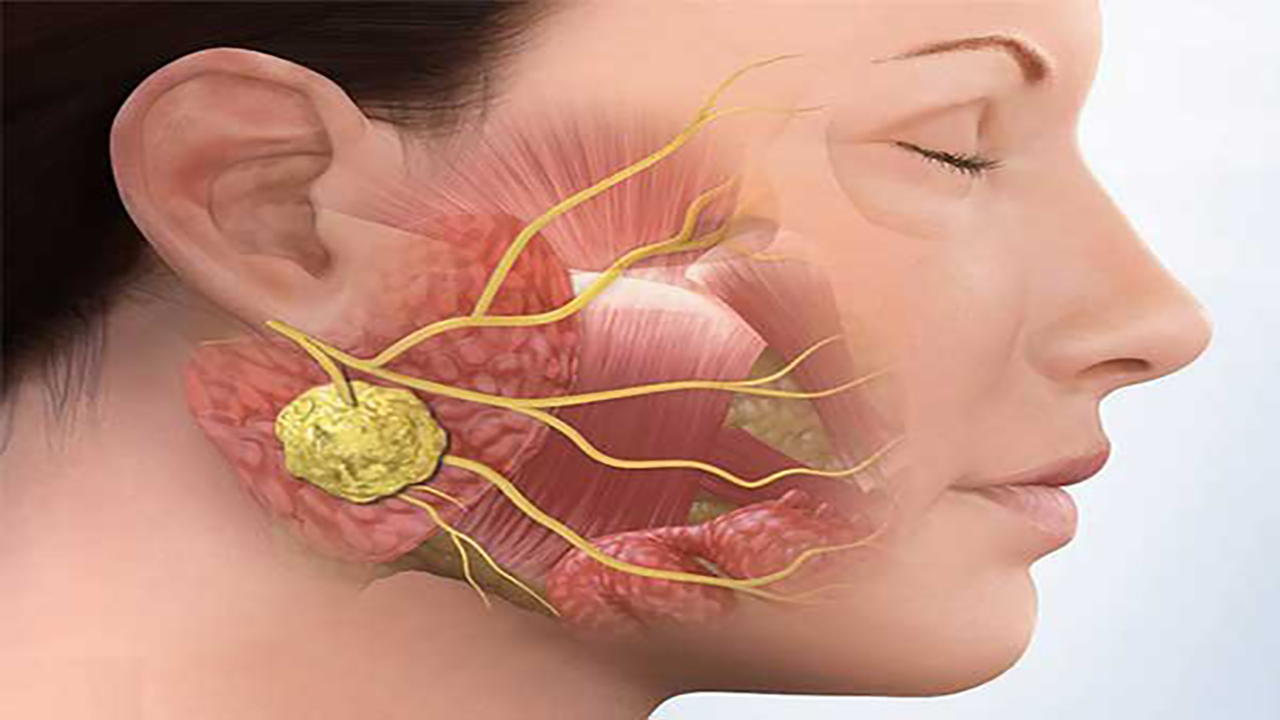 Khám sinh thiết hạch ở tai, bắt trọn bệnh lý