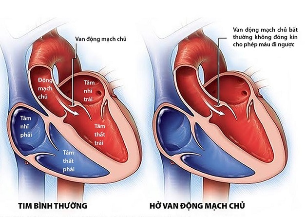 Khám tim mạch hở van động mạch chủ khi nào, ở đâu?