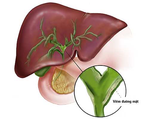 Khám và chữa trị viêm đường mật