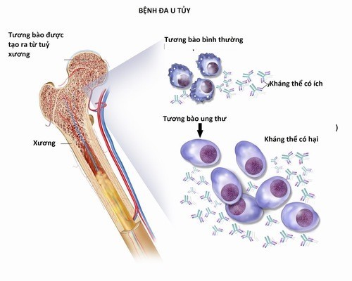 Khám và điều trị bệnh đa u tủy xương