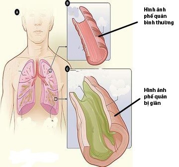 Khám và điều trị bệnh giãn phế quản