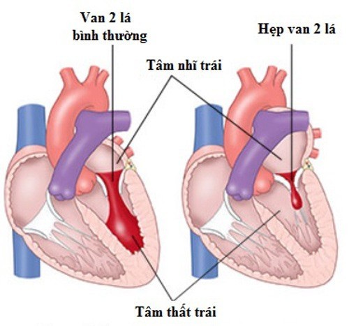 Khám và điều trị bệnh hở van tim