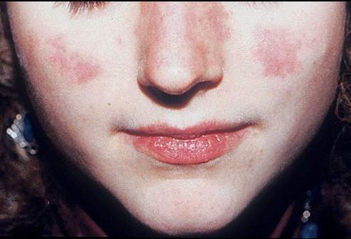 Khám và điều trị bệnh lupus ban đỏ hệ thống