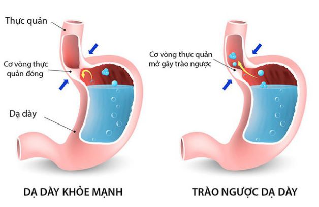 Khám và điều trị bệnh trào ngược dạ dày thực quản ở trẻ em