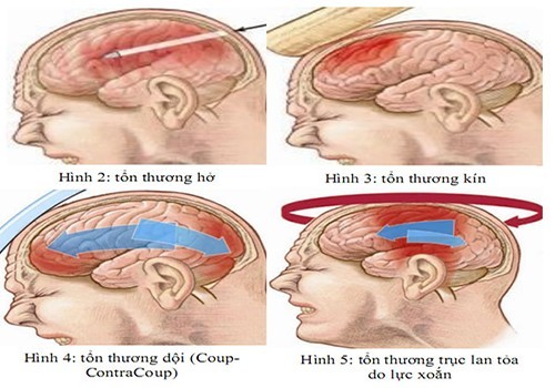 Khám và điều trị chấn thương sọ não