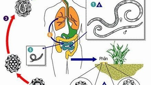 Khám và điều trị giun chui ống mật bằng cách nào?