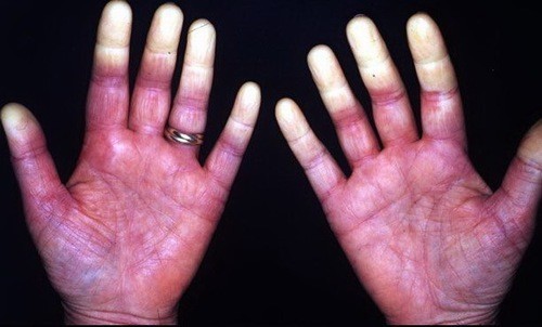 Khám và điều trị hội chứng Raynaud