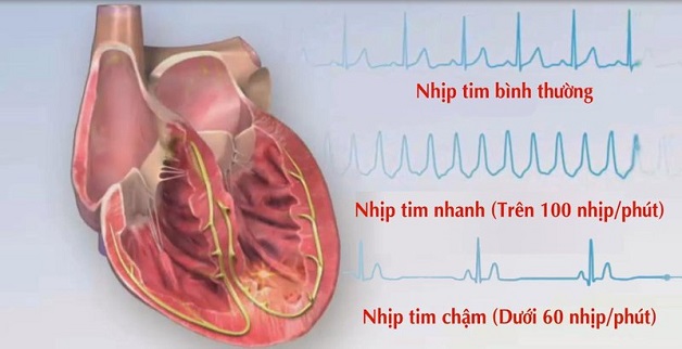 Khám và điều trị rối loạn nhịp tim