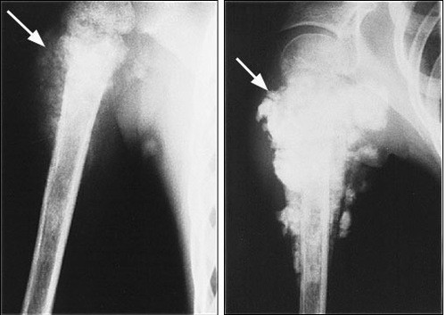 Khám và điều trị Sarcoma tạo xương