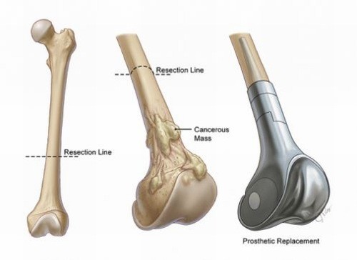 Khám và điều trị Sarcoma tạo xương