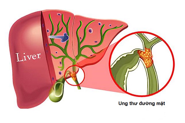 Khám và điều trị ung thư đường mật