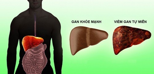 Khám và hỗ trợ điều trị viêm gan tự miễn