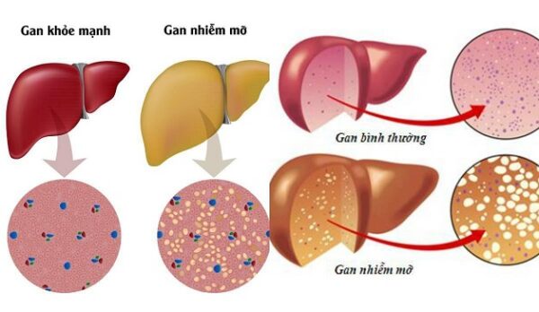 Khi bị gan nhiễm mỡ kiêng những thứ gì?