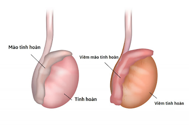 Khi bị viêm tinh hoàn khám ở đâu uy tín, chất lượng tốt nhất