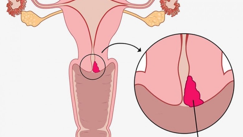 Khí hư màu hồng nhạt – nguyên nhân và cách xử trí!