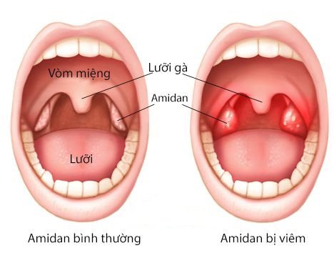 Khi nào cần cắt Amidan? Cắt Amidan có đau không?